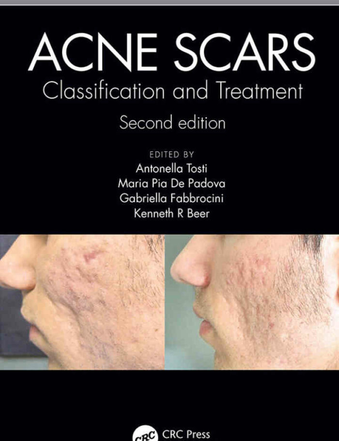 Acne Scars: and Treatment Acne Scars: and Treatment