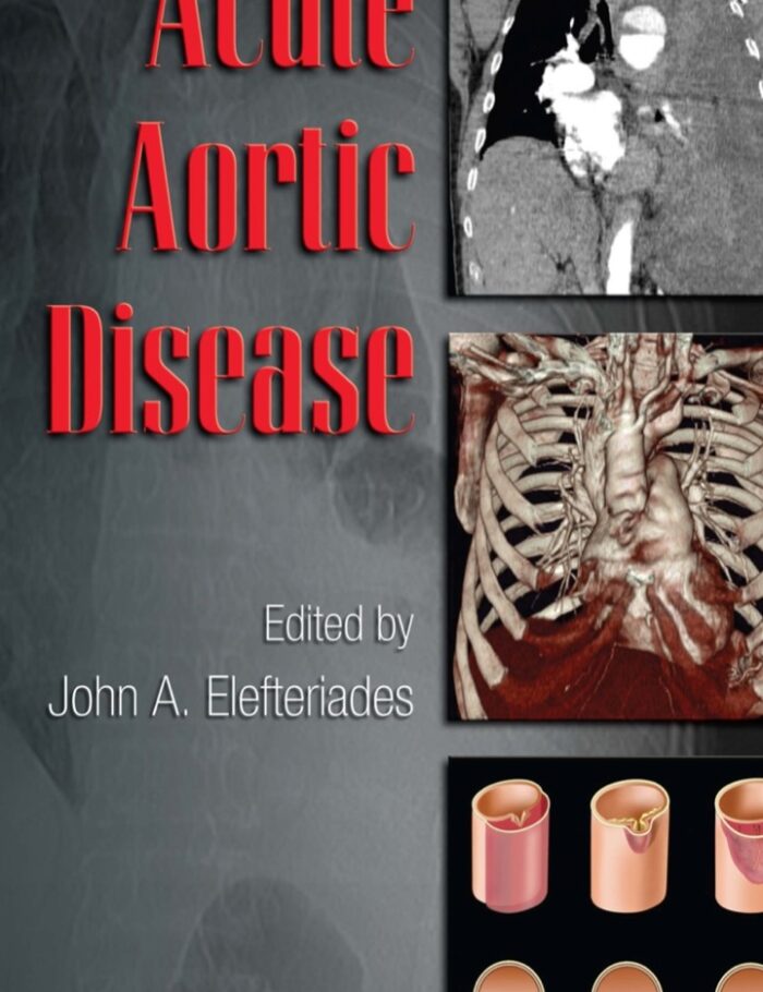 Acute Aortic Disease