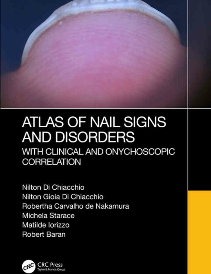 Atlas of Nail Signs and Disorders with Clinical and Onychoscopic Correlation