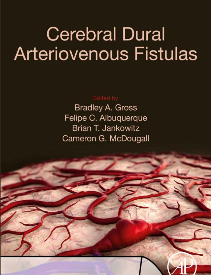Cerebral Dural Arteriovenous Fistulas