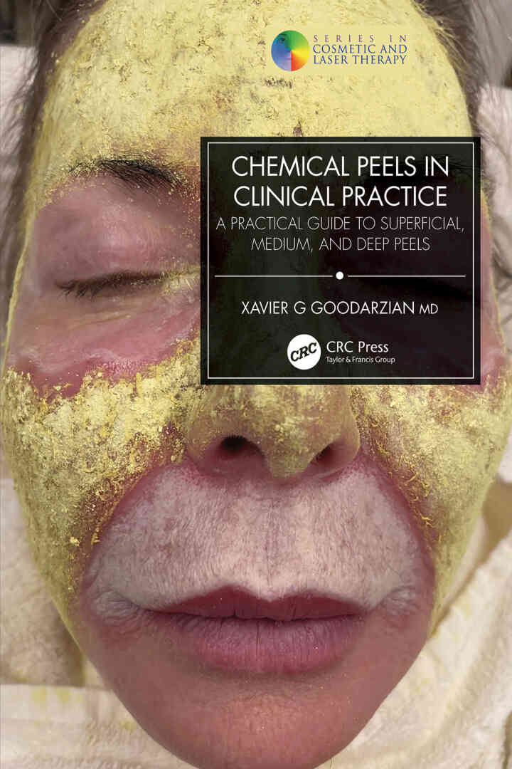 Chemical Peels in Clinical Practice: A Practical Guide to Superficial Medium and Deep Peels